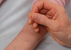 acupuncture-treatment-1